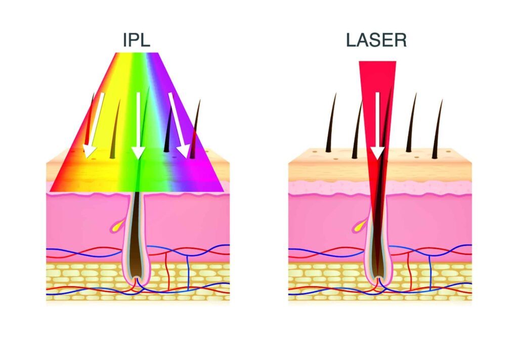 Comparison of IPL and laser hair removal on skin diagram